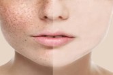 Pigmentation